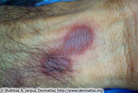 dark red/purple spots on person's arm