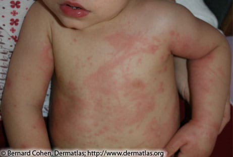red splotchy rash on the torso and arms of a toddler