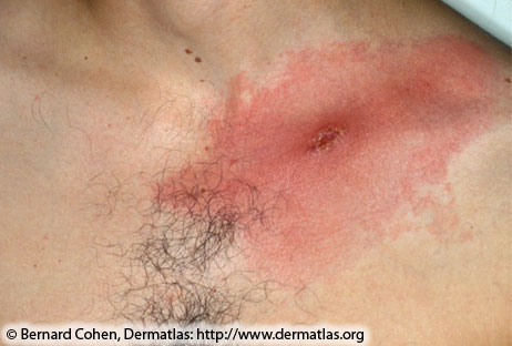 Image of a red rash with a lesion on persons shoulder.