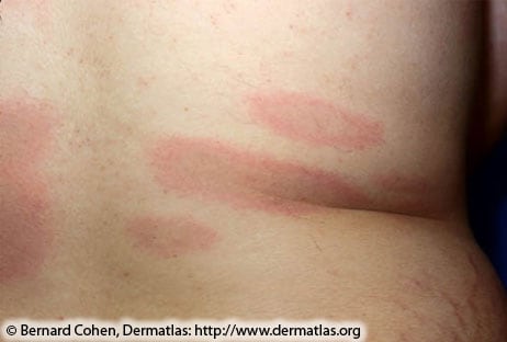 Early disseminated Lyme disease; multiple red lesions with dusky centers