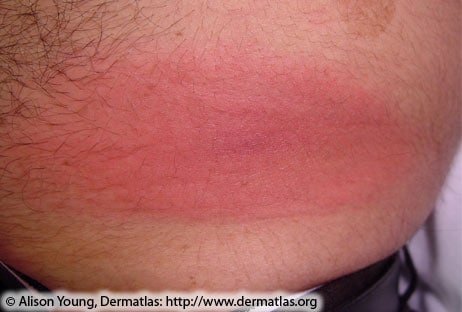 Image of a large red oval-shaped rash on a person's torso.