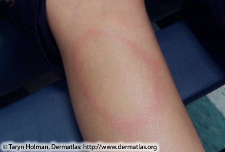 Image of a circular red rash with central clearing on person's arm