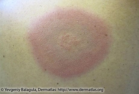 Bluish hued circular rash on person's skin.