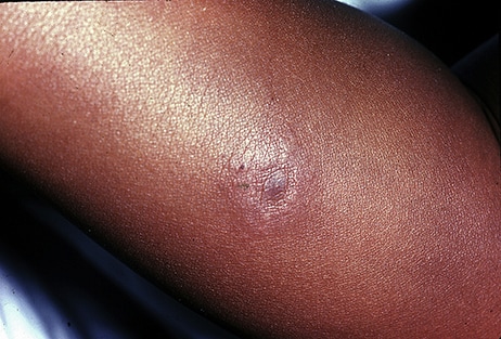 Early, expanding erythema migrans with nodule