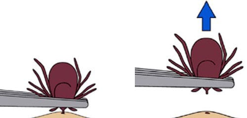 clipart style image showing the proper removal of a tick using a pair of tweezers