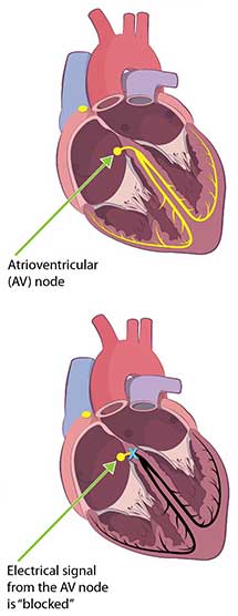 Cutout images of a heart showing third degree block
