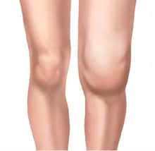 swollen knee