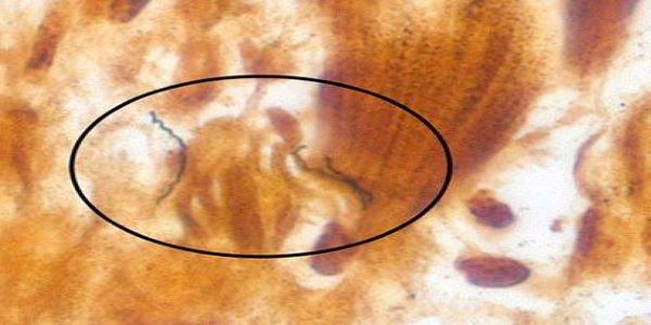 Clinical Care and Treatment of Lyme Carditis | Lyme Disease | CDC