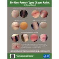 The many forms of Lyme Disease rashes poster thumbnail