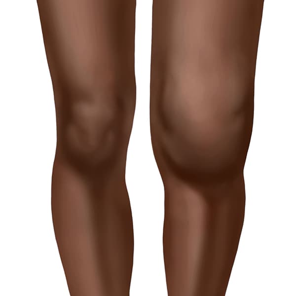 Image showing swollen arthritic knee