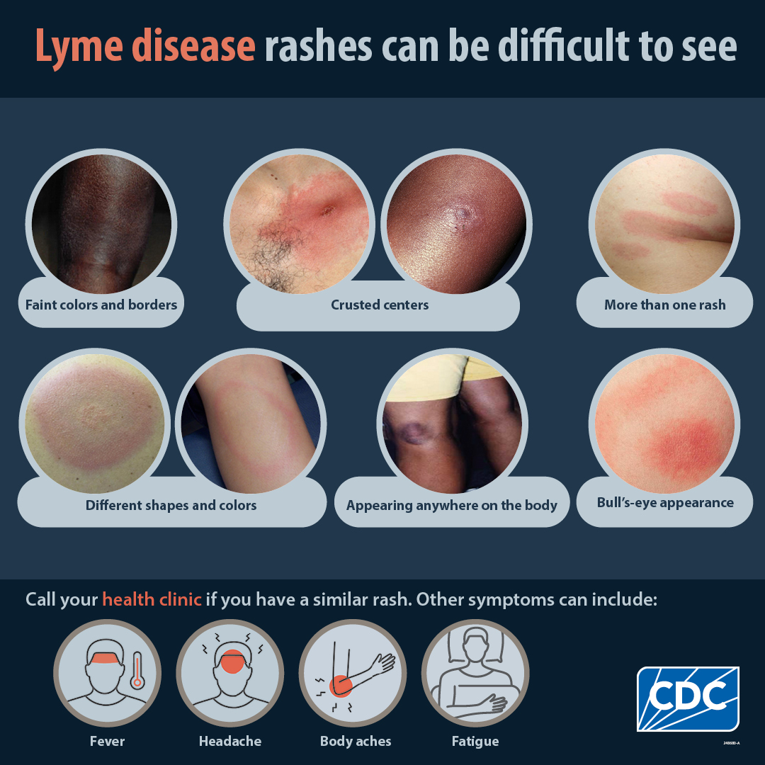 Lyme Disease Rashes Lyme Disease CDC