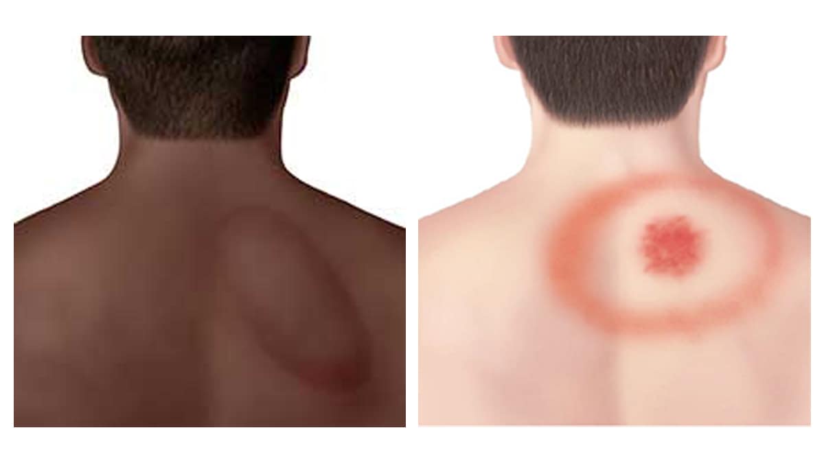 Erythema migrans rashes on two different skin tones to show the wide variety of appearances.