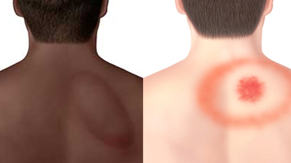 Illustration of erythema migrans on different colored skin tones.