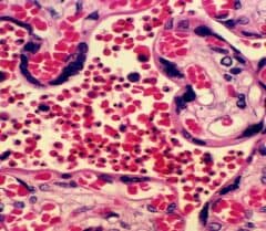 photomicrograph of a placenta, packed with infected red cells