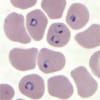 Plasmodium falciparum parasites in a thin blood smear.