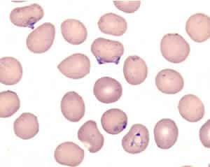 Blood smear showing 5 parasites of Plasmodium falciparum