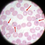 Blood smear from a patient with malaria; microscopic examination shows <em>Plasmodium falciparum</em> parasites with arrows pointing at the patient's infected red blood cells. (CDC photo)