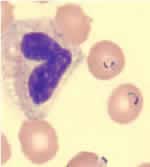 Blood smear stained with Giemsa, showing a white blood cell (on left side) and several red blood cells, two of which are infected with Plasmodium falciparum (on right side).