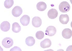 photomicrograph showing approximately 18 red cells, three of which are infected with ring-stage parasites of Plasmodium falciparum