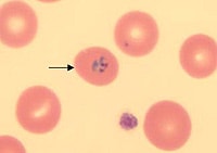 Blood smear from Tom Miller during his illness, showing several red blood cells, one of which (arrow) is infected by a malaria parasite.