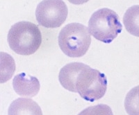 Blood smears from Stuart Ver Wys, showing red blood cells infected by Plasmodium falciparum malaria parasites.