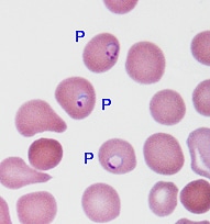 Blood smear taken from Ms. Jones in the emergency room and examined under the microscope, showing that many of the red blood cells are infected.
