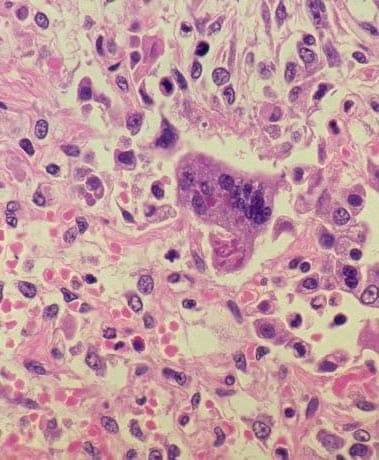 Histopatología de la neumonía por sarampión (célula gigante con inclusiones intracitoplasmáticas).