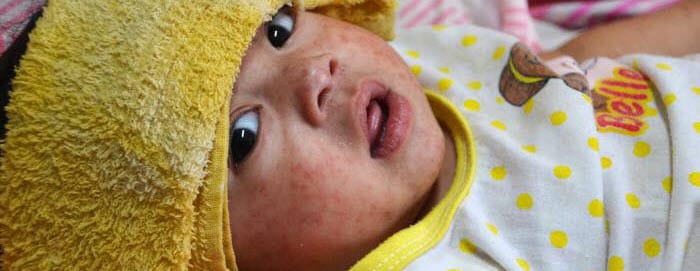 Baby in a hospital with measles (rubeola) with a damp cloth on the forehead