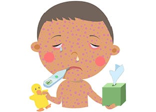Illustration of child with measles