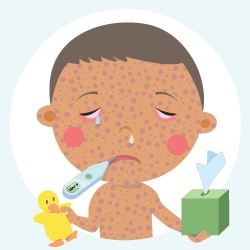 Illustration of child with measles. Child holds a box of tissues and a toy ducky.