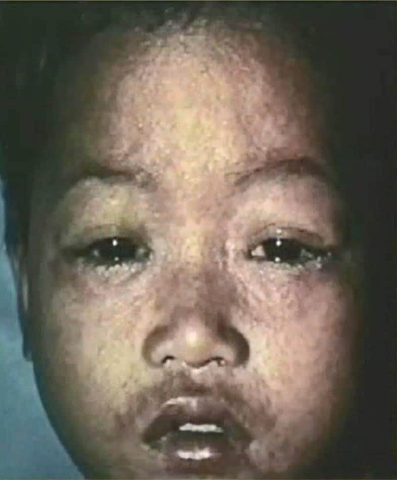 Young, dark-skinned child with watery eyes, runny nose, and raised rash.