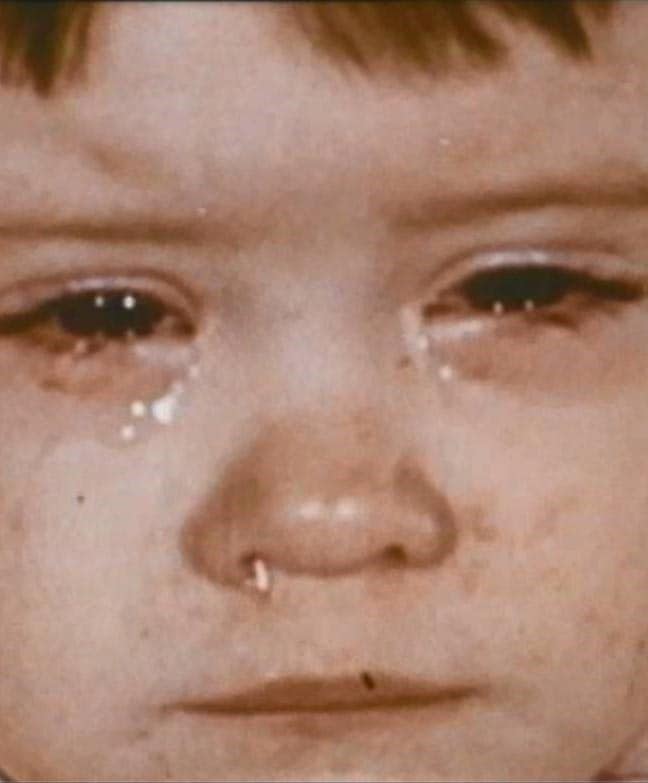 Niño pequeño con enfermedad moderada: moqueo, ojos llorosos causados por la infección por sarampión.