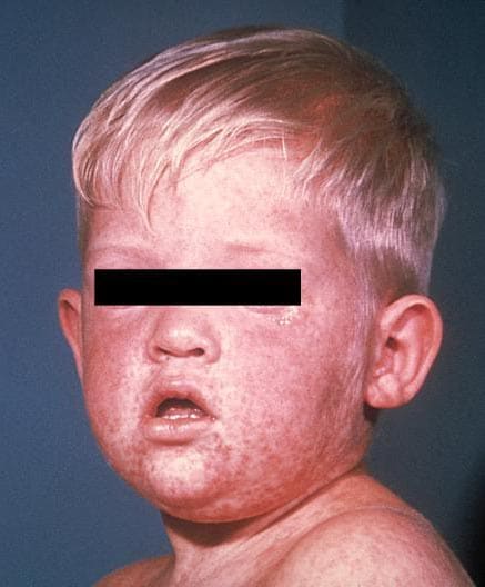 Cara de un niño después de tres días con el sarpullido del sarampión.