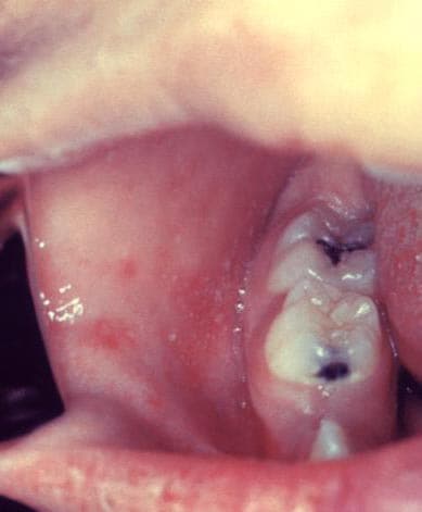 Close-up of the inside of the mouth of a patient with Koplik spots three days after measles