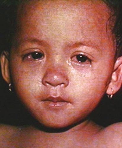 Watery eyes of a young child with measles