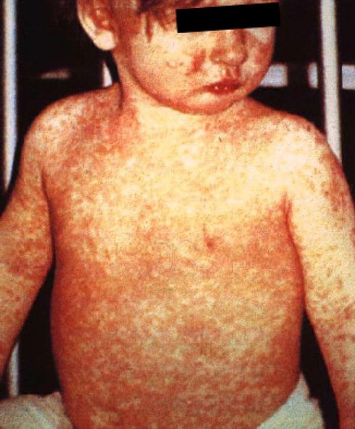 Un niño pequeño con sarpullido del sarampión.en la parte superior del cuerpo y los brazos