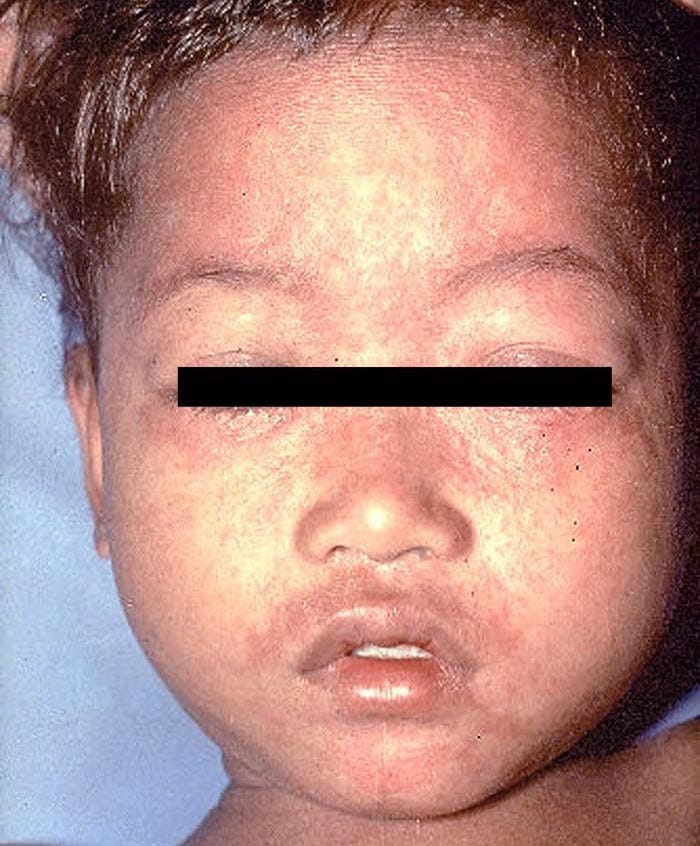 Face of child with measles.