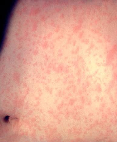 Skin of a patient after 3 days of measles infection.