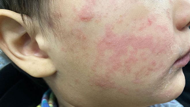 Image of measles rash on cheeks.