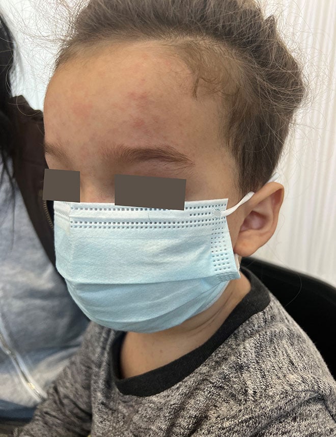 Image of measles rash on forehead.
