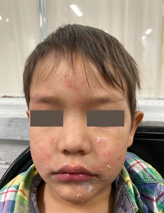 Image of measles rash on Childs face and cheeks.