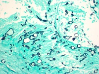 Microscopic examination of tissue from meningitis patients