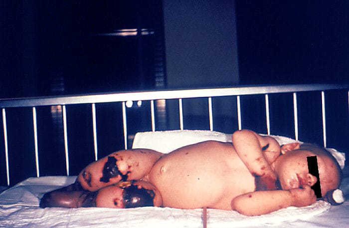 Infant with gangrene on her hand and legs laying on a bed.