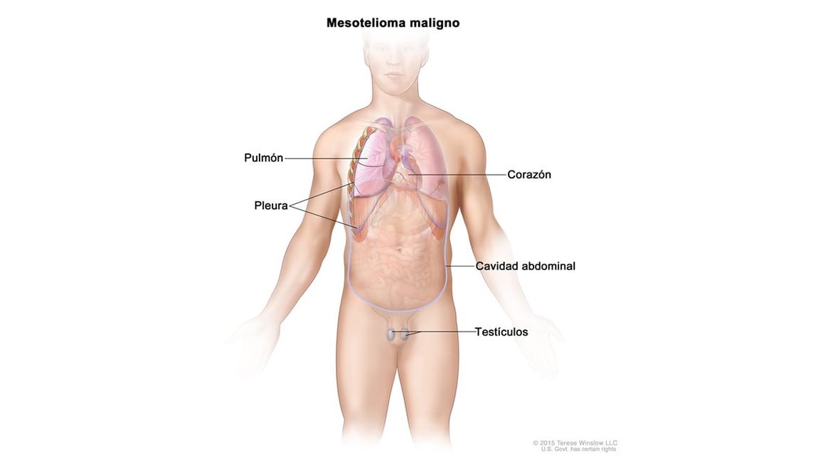 Diagrama que muestra partes del cuerpo donde se puede formar mesotelioma maligno