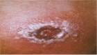  Skin destruction, or vaccinia necrosum at the site of a smallpox vaccination.