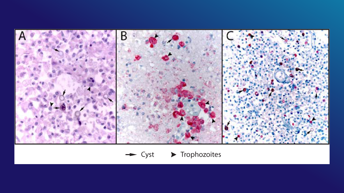 Notes from the Field: Fatal Acanthamoeba Encephalitis in a Patient Who Regularly Used Tap Water in an Electronic Nasal Irrigation Device and a Continuous Positive Airway Pressure Machine at Home — New Mexico, 2023 The image shows a series of 3 photos depicting the histopathologic findings in a fatal case of granulomatous amebic encephalitis caused by Acanthamoeba T4 genotype.