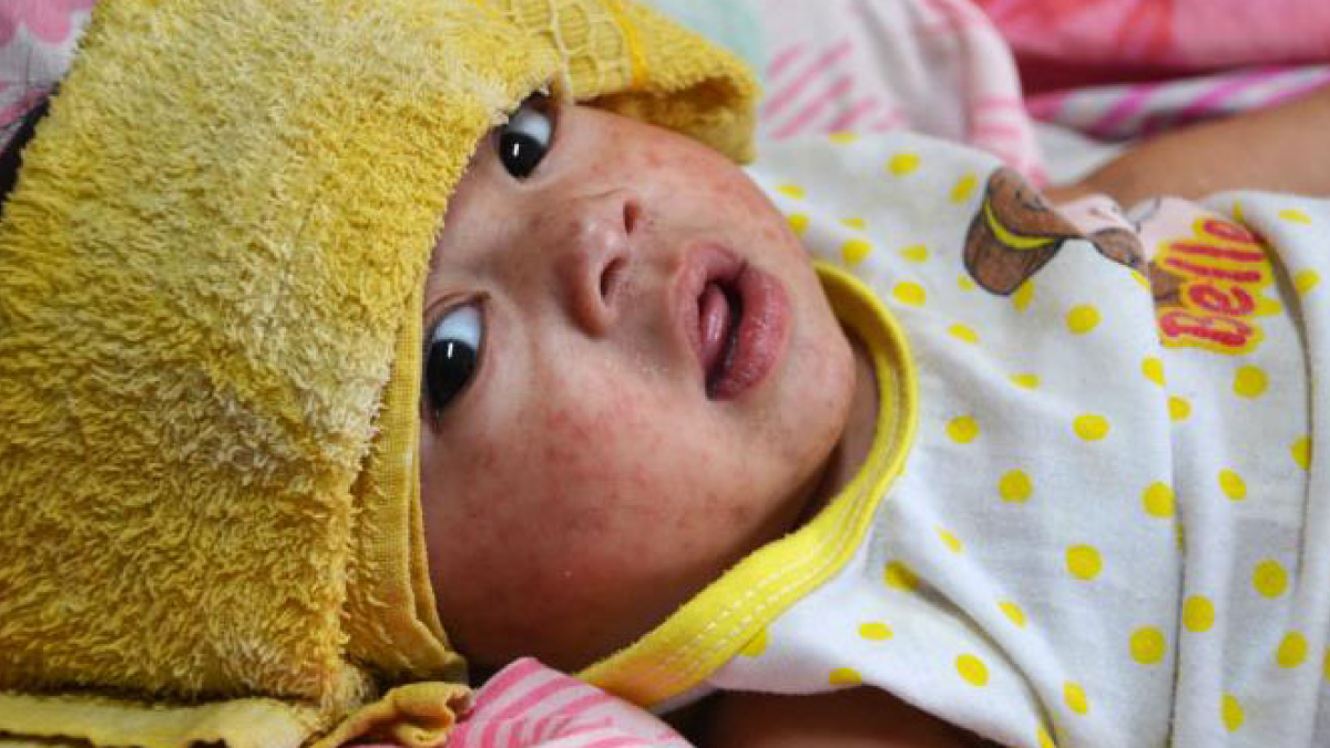 The image shows a baby with measles with a washcloth across their forehead.