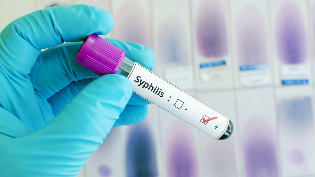 Notes from the Field: Neurosyphilis, Ocular Syphilis, and Otic Syphilis — Chicago, January–October 2023 The image shows a gloved hand holding a test tube that has a positive syphilis result.