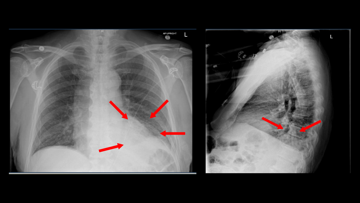 Notes from the Field: Increase in Human and Animal Tularemia Cases — Minnesota, 2024 Chest X-ray of a 72-year-old male with pneumonic tularemia, showing mixed interstitial and alveolar infiltrates in the left lung.