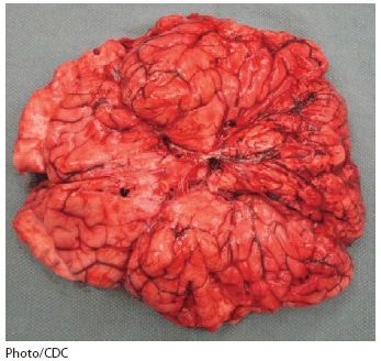 The figure shows a brain at autopsy of a decedent with suspected rabies infection in Indiana during 2009. At autopsy, the brain weighed 1,610 g (normal: 1,300-1,400 g) and showed markedly congested and hemorrhagic leptomeninges.